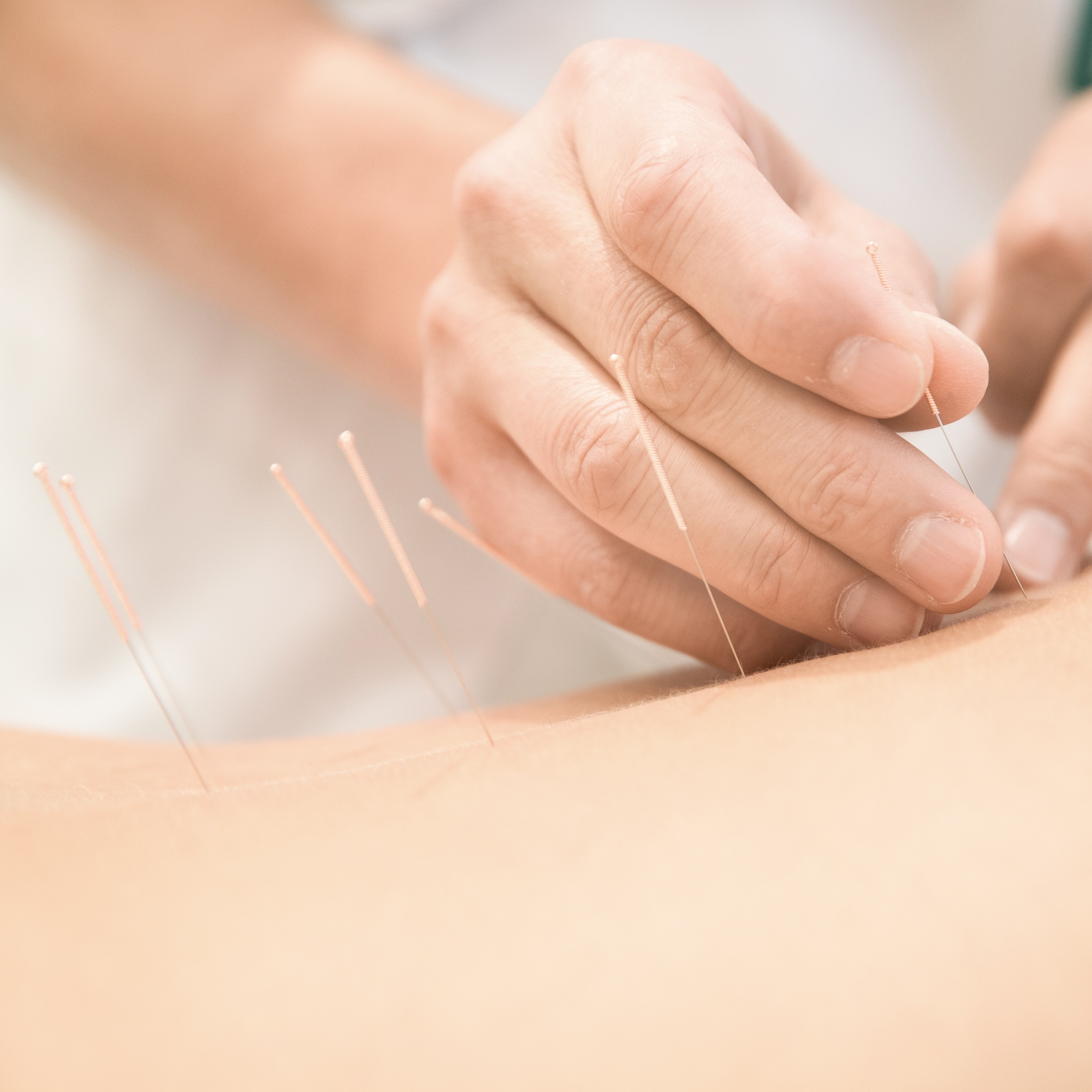 /acupuncture